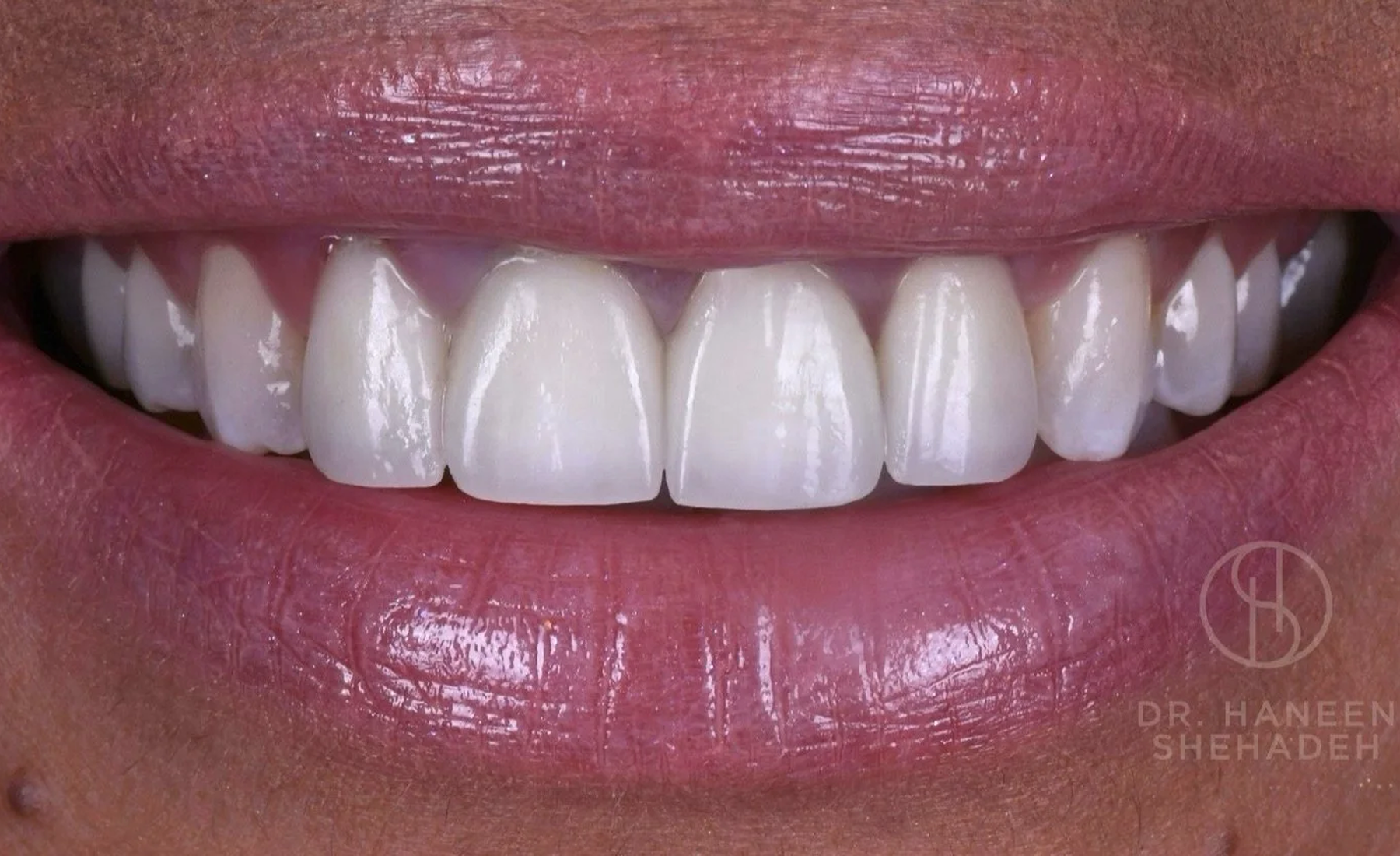 Before - smile transformation by Dr. Shehadeh at Ember Dental