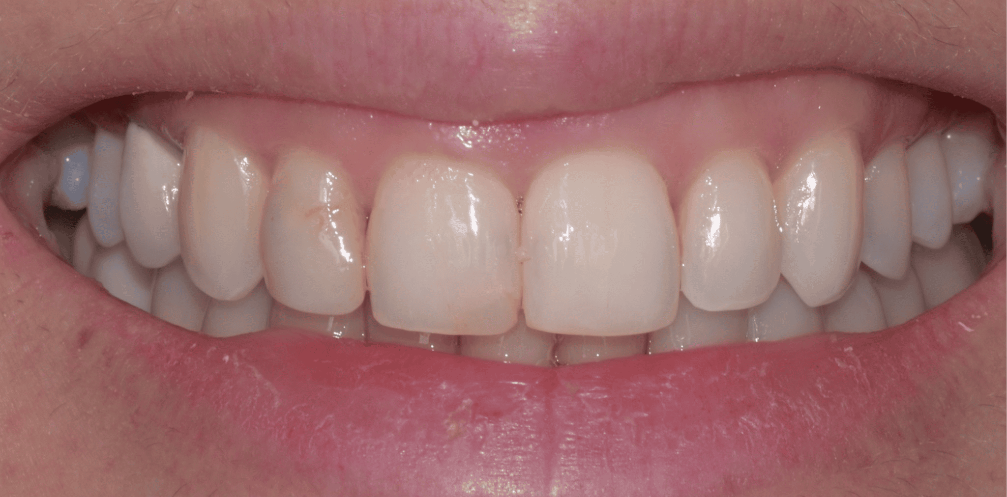 After - patient smile transformation at Ember Dental, South Florida