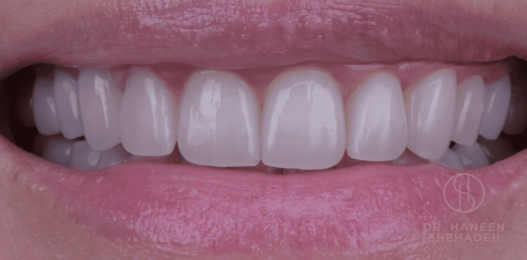 Before - patient smile treatment at Ember Dental, South Florida