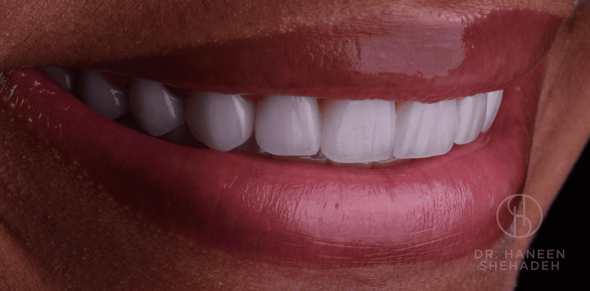 Before - dental educational treatment example at Ember Dental