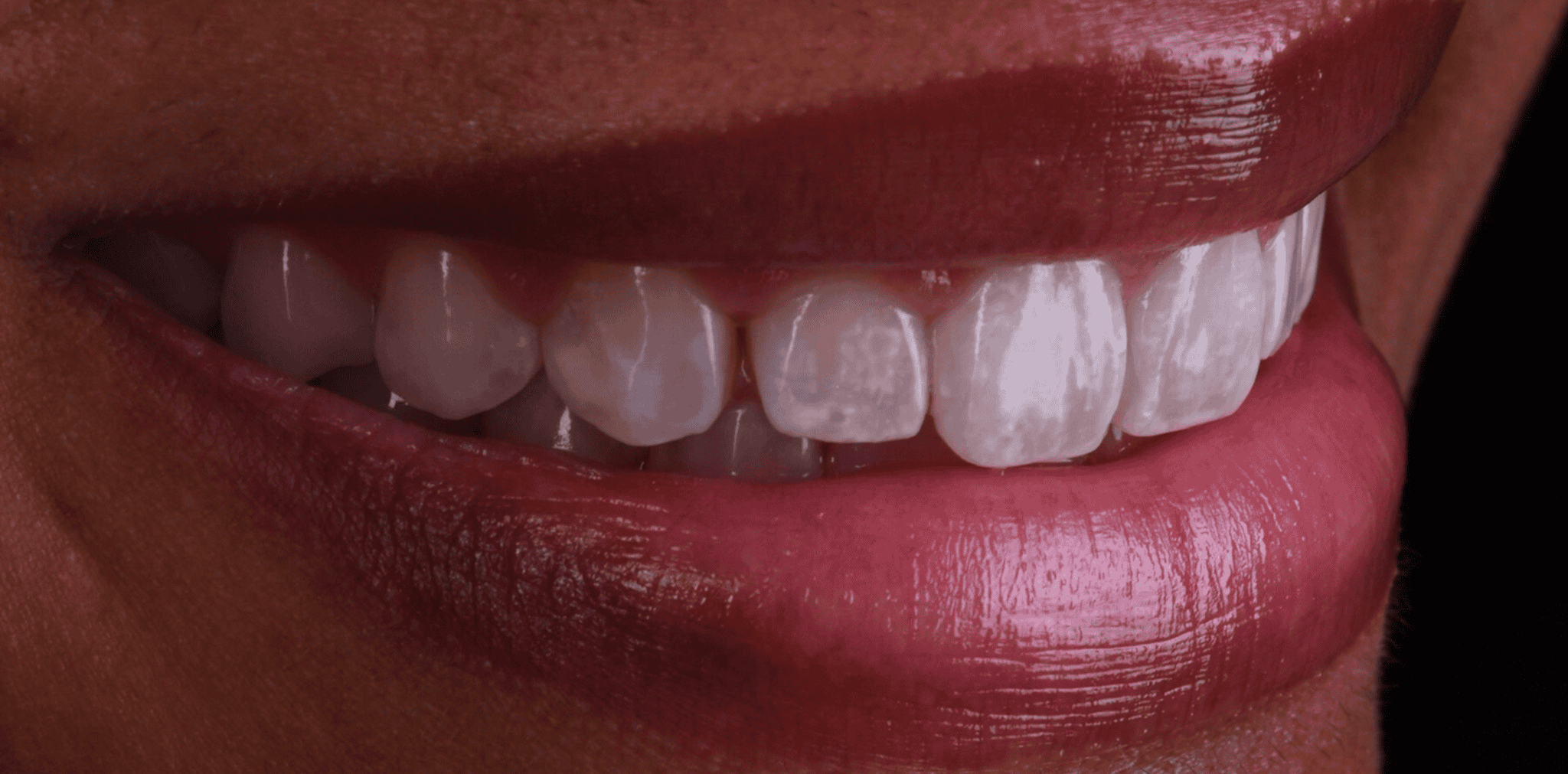 After - dental treatment result at Ember Dental, Deerfield Beach, FL